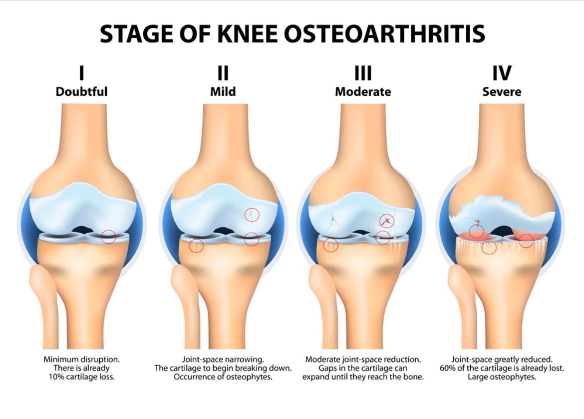 ارتروز زانو